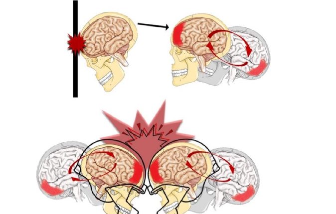 How to recover from a concussion faster